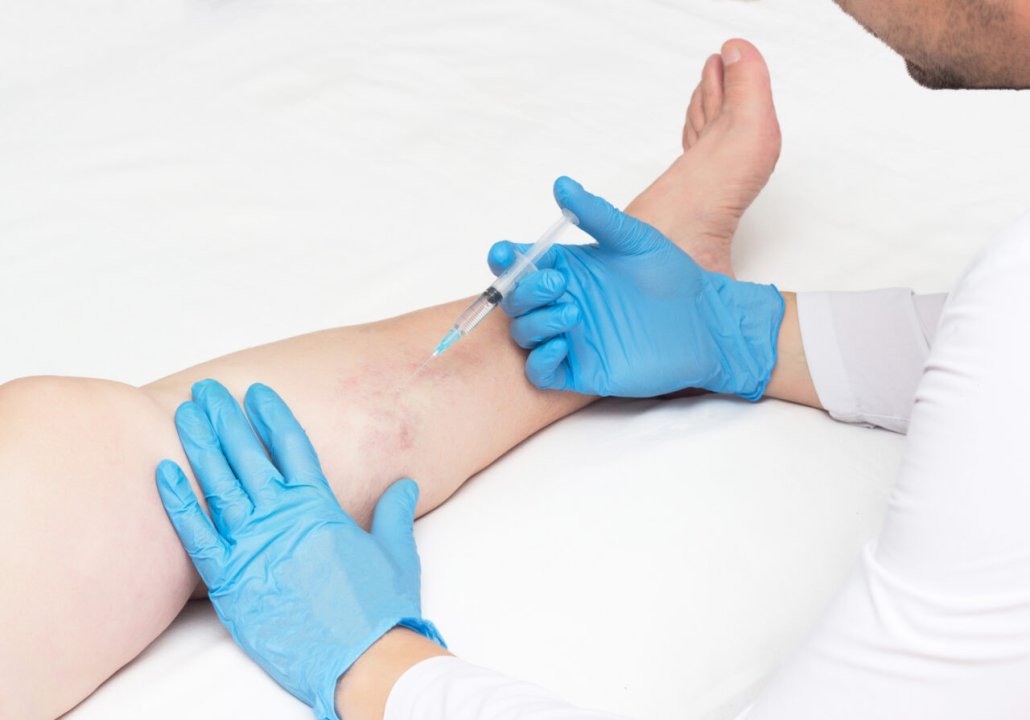 Copy-of-Sclerotherapy-shutterstock_1283406964-Copy-1280x895-1.jpg