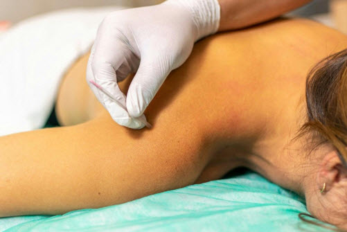 Your Clandestine Gadget for Treating Back Misery: Dry Needling in Singapore Your Clandestine Gadget for Treating Back Misery: Dry Needling in Singapore